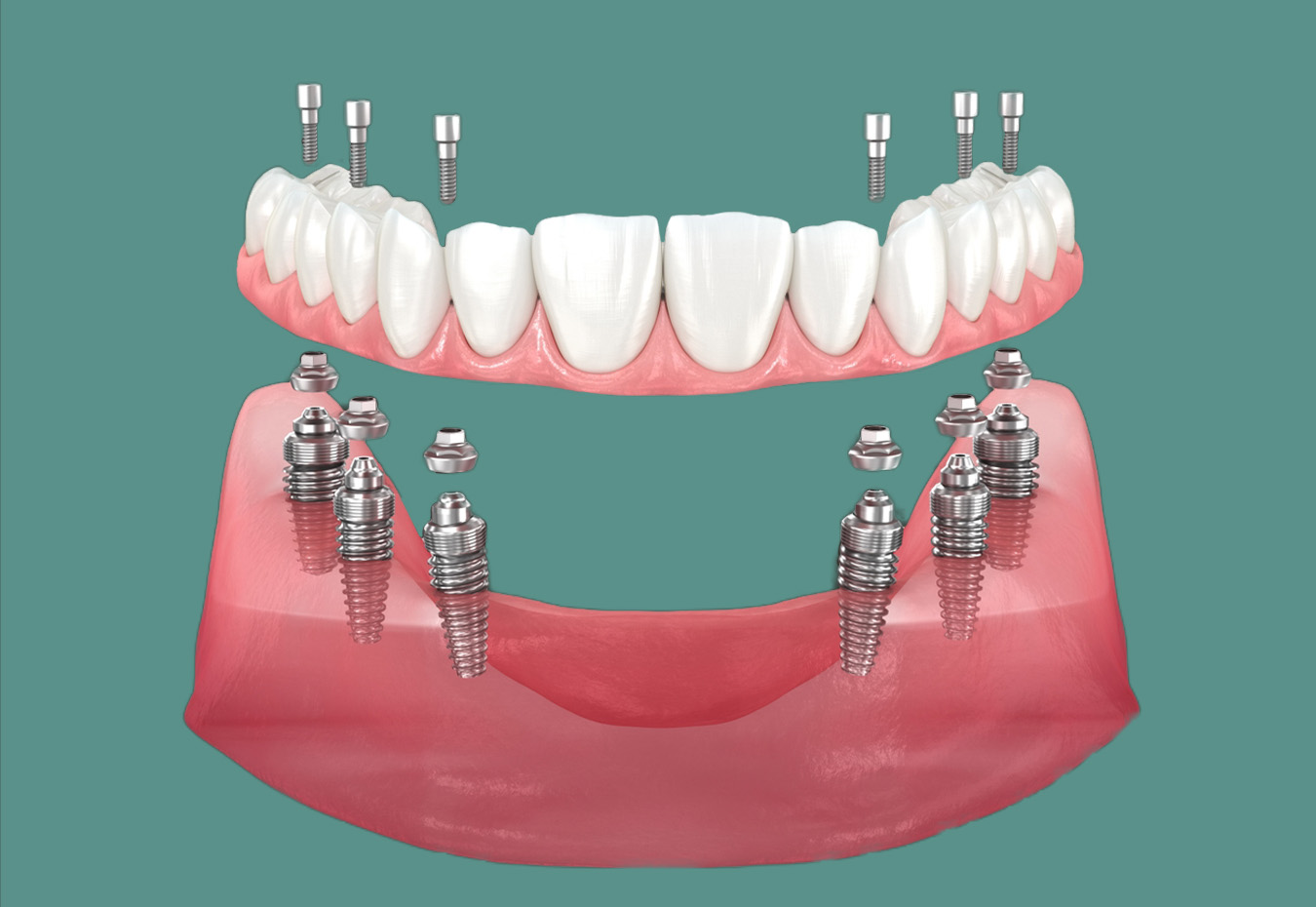 All-on-4 dental implants
