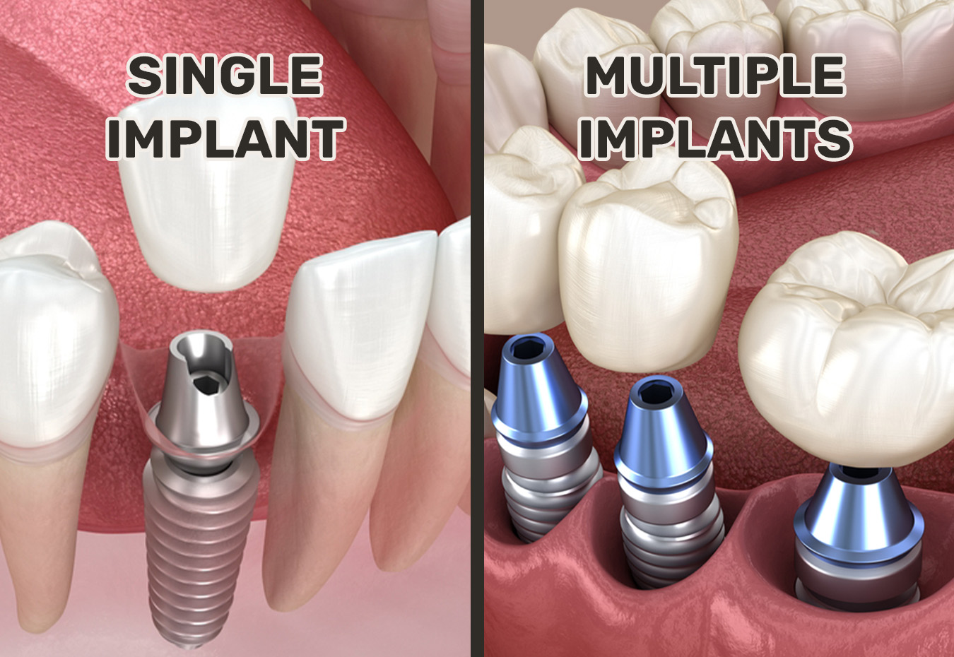 Single tooth dental implant
