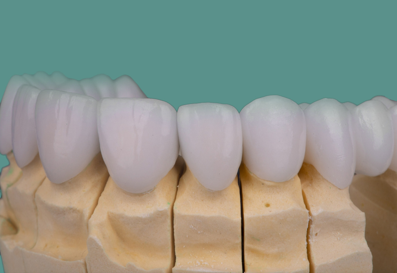 Bone grafting for dental implants
