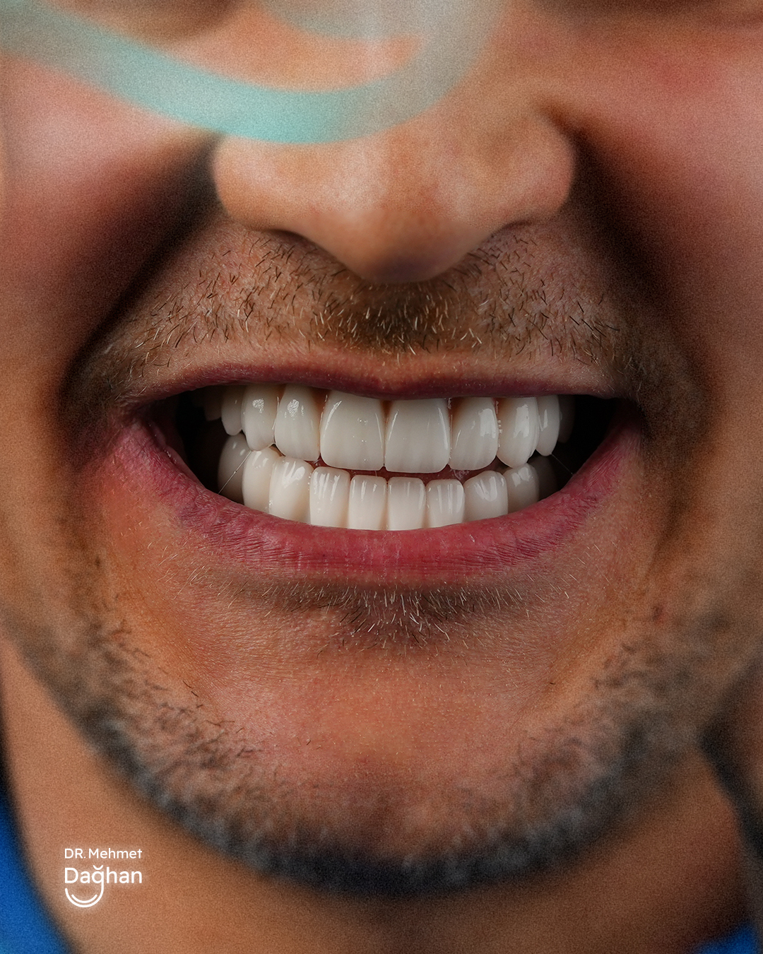 Smile case