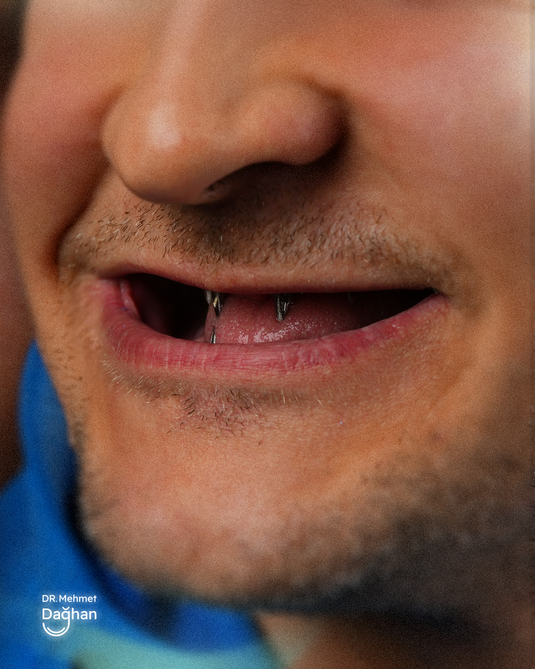 Smile case