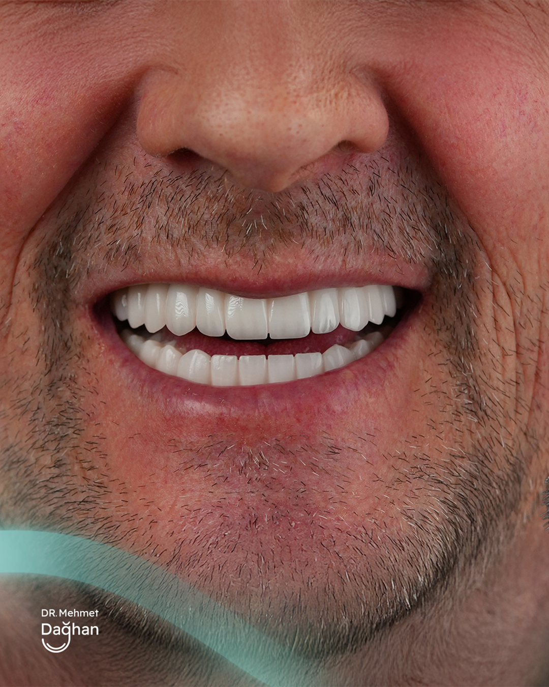 Smile case