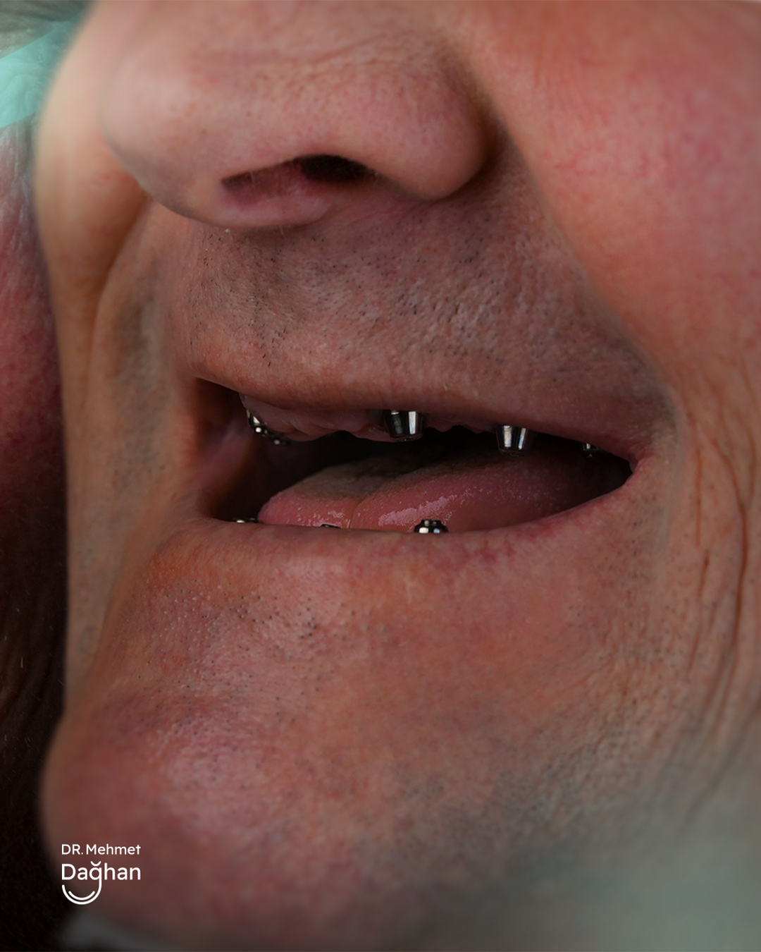 Smile case