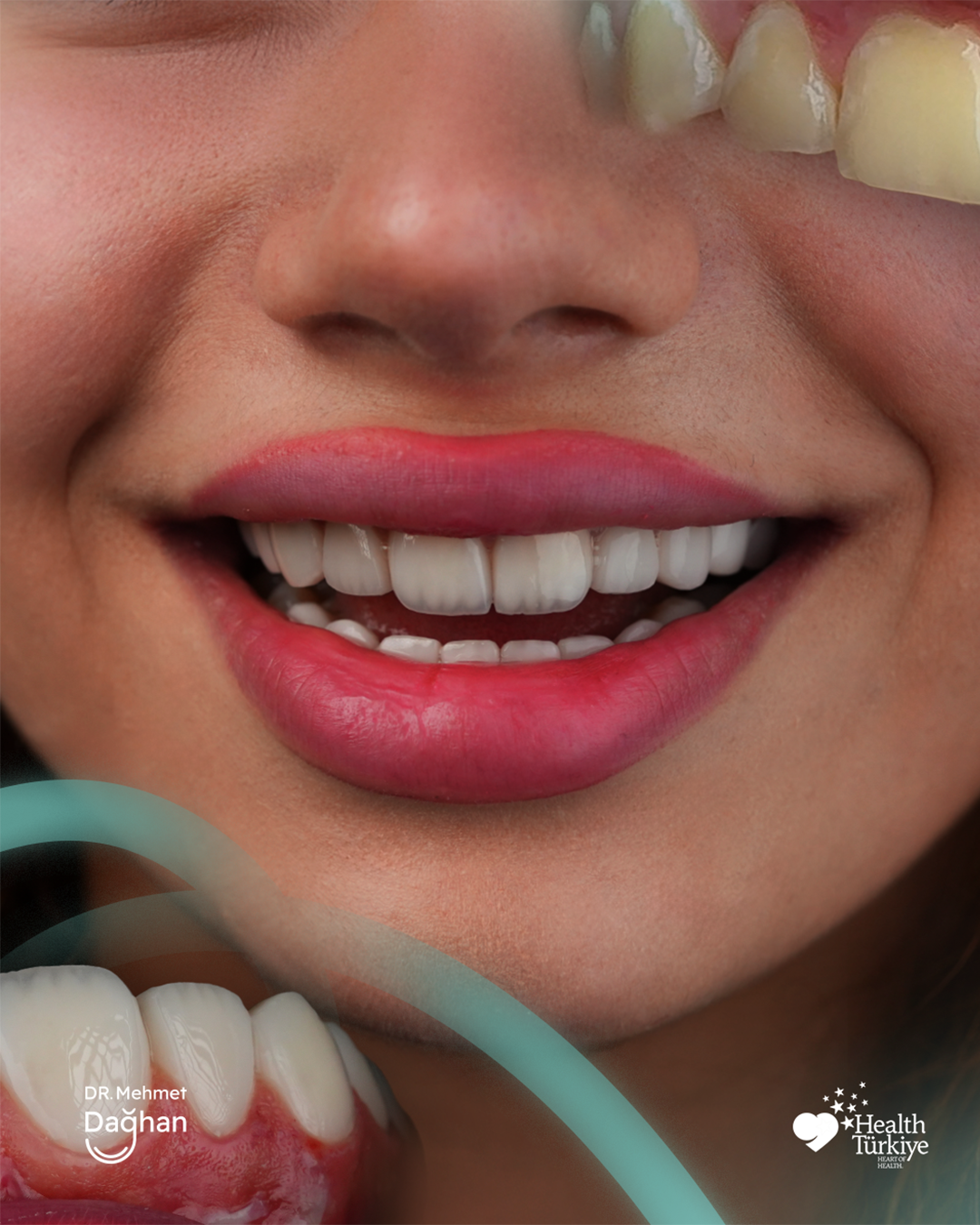 Smile case