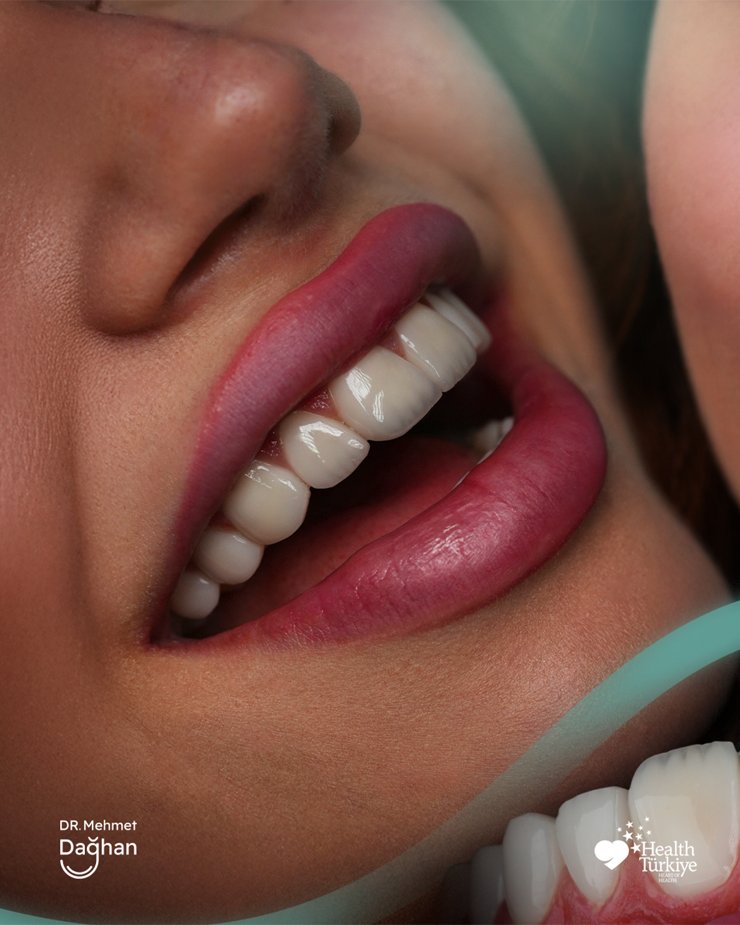 Smile case