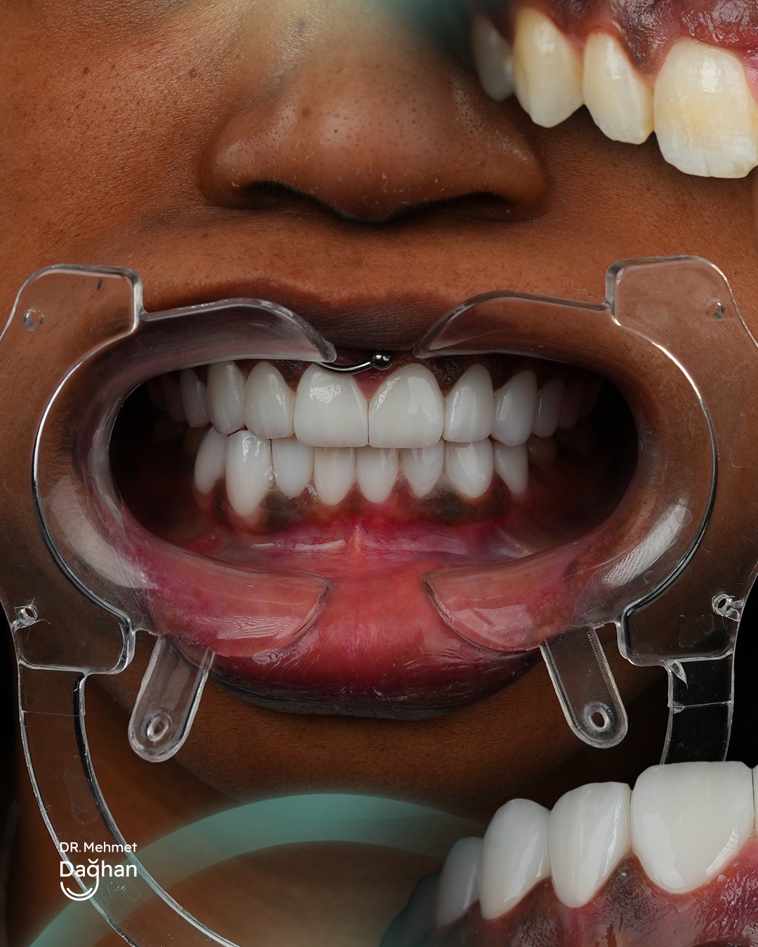 Smile case