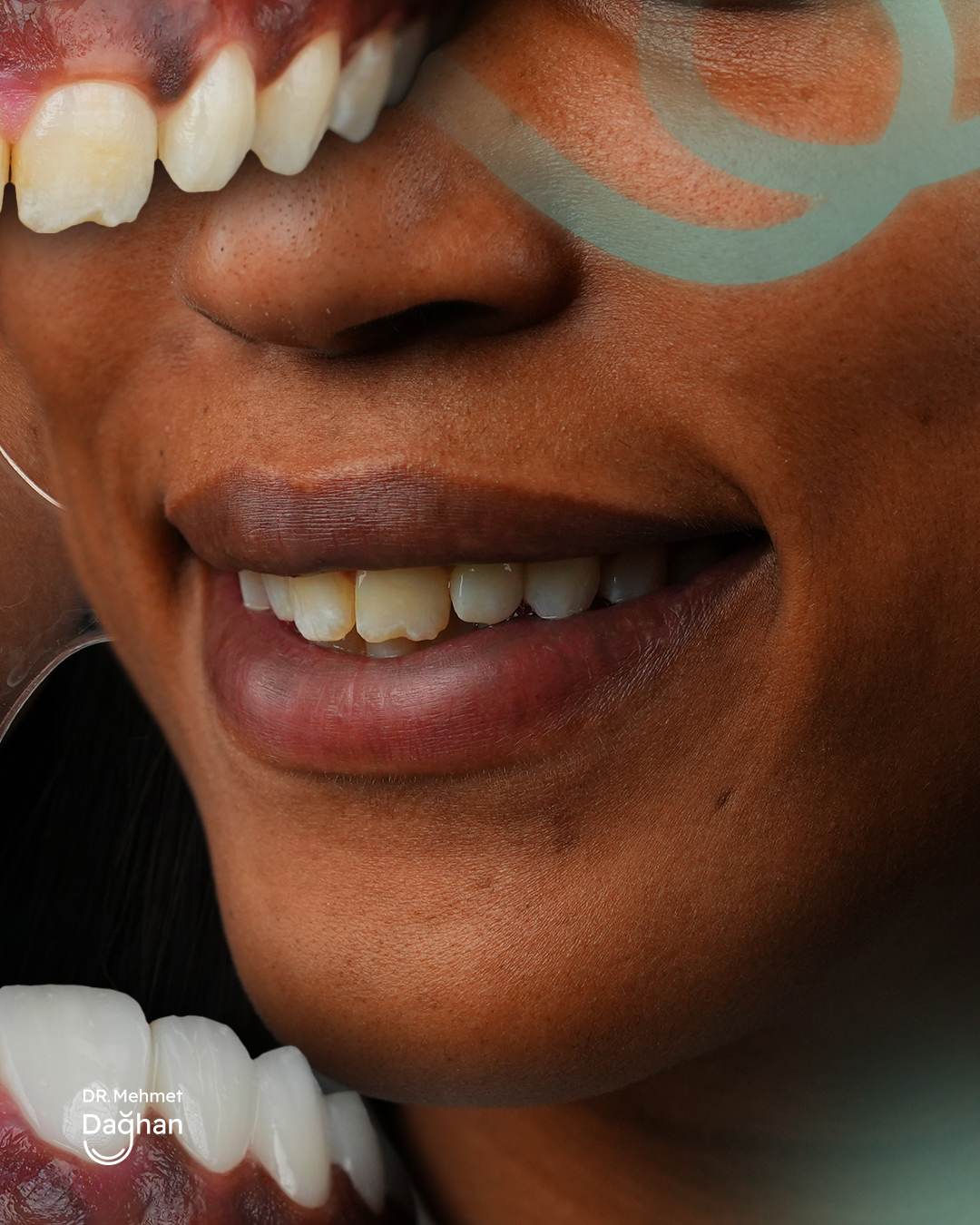Smile case
