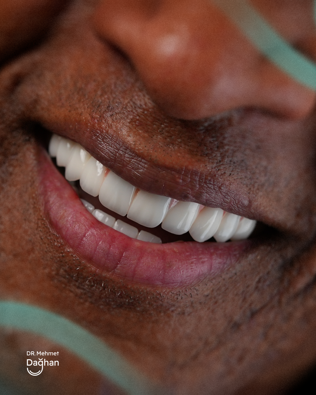 Smile case