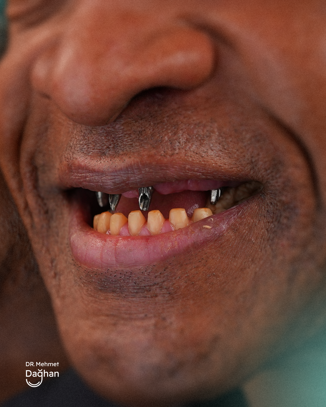 Smile case