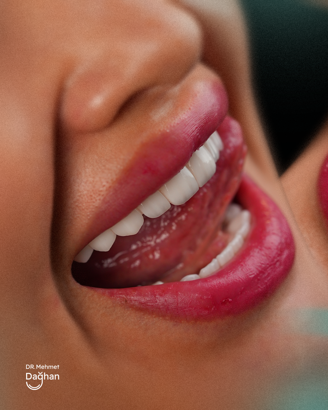 Smile case