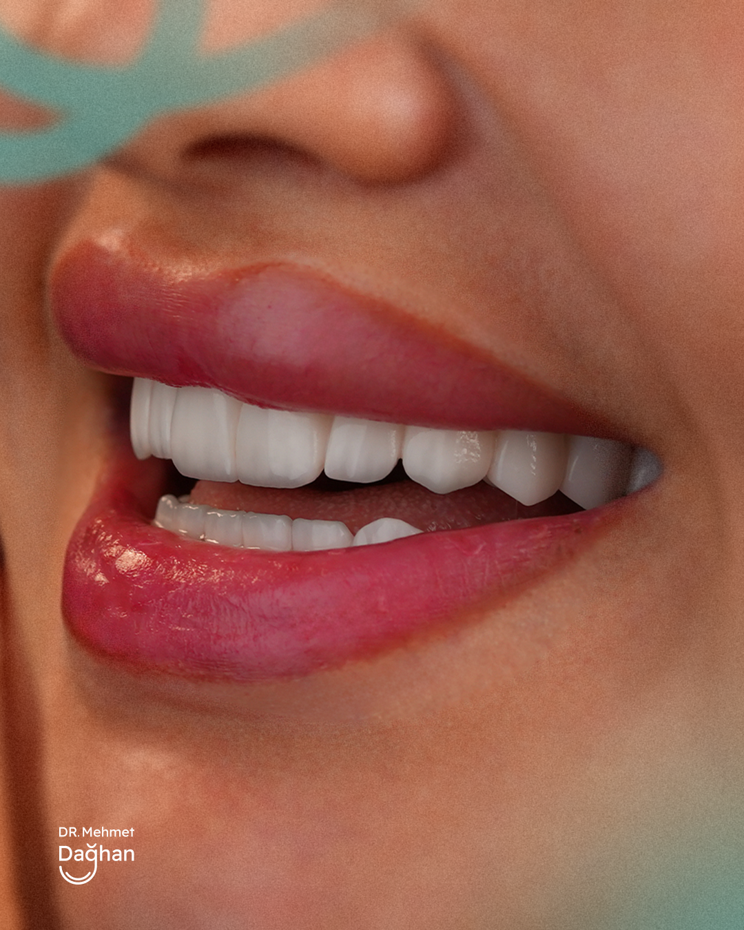 Smile case